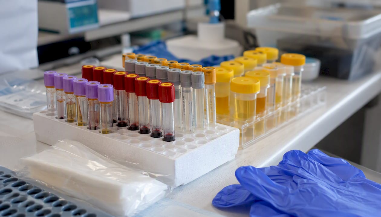 Blood and urine test tubes for life insurance exam